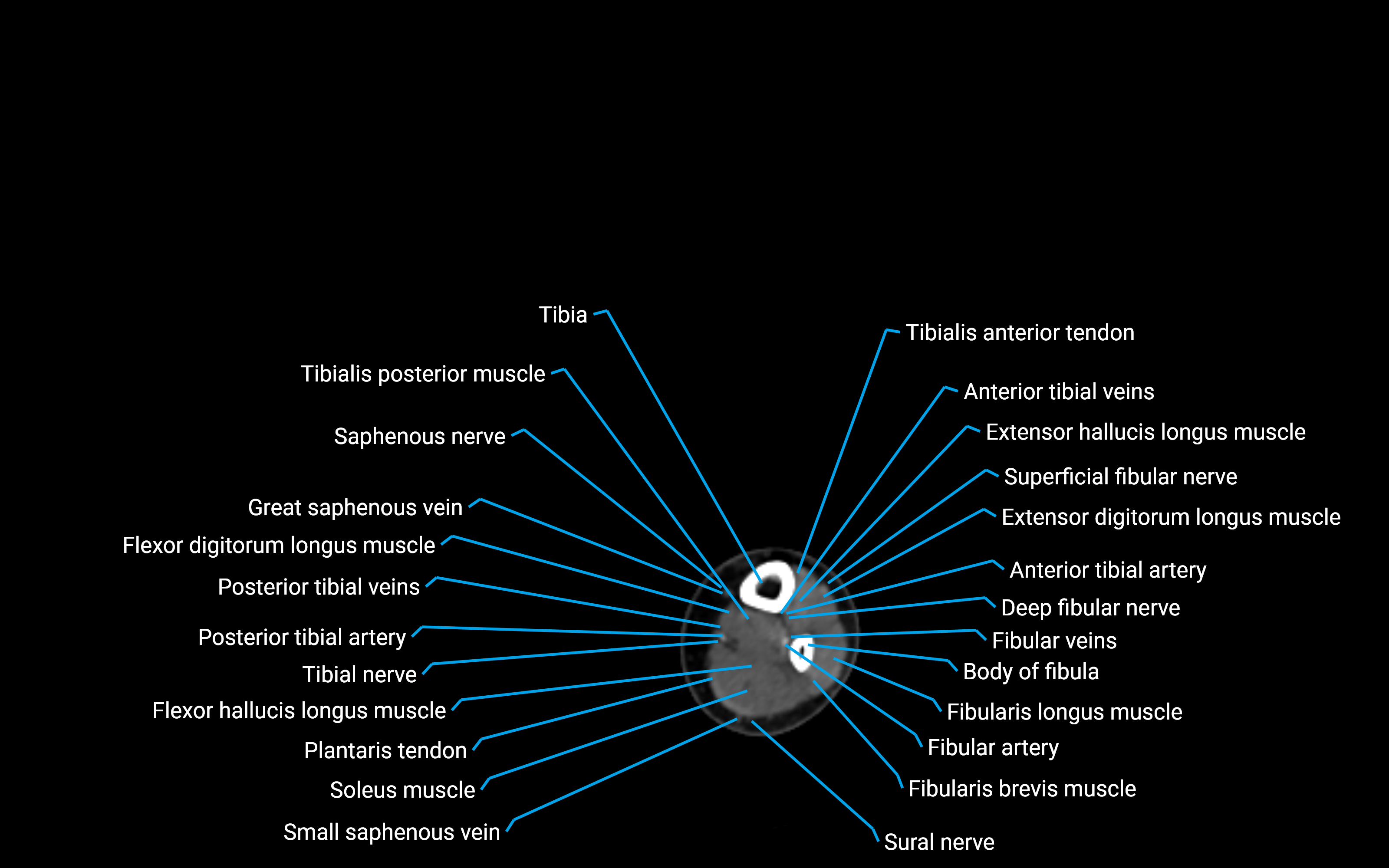 CT Lower leg axial cross sectional anatomy labelled image 146 (2).png
